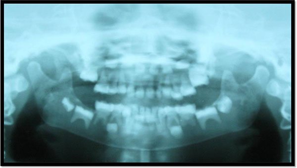 Child Dental head Phantom Panaramic X-ray Image SPoRT