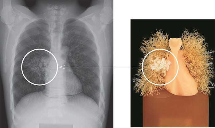 LUNGMAN Pneumonia Kit