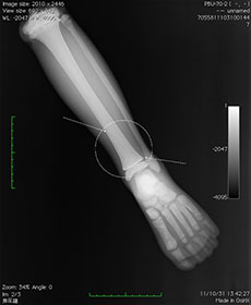 PBU-70 Lower Leg With Pathology Top View X-Ray
