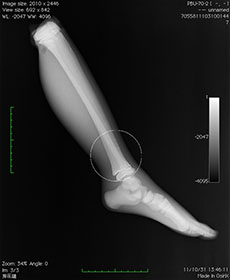 PBU-70 Lower Leg With Pathology Lateral View X-Ray