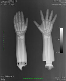 PBU-70 Forearm & Hands. Left Hand Relaxed. Right Hand Flat X-Ray