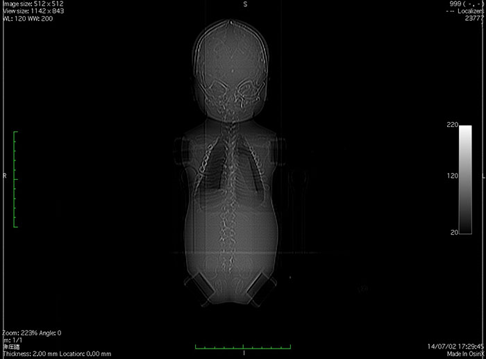 Whole Body Newborn Baby Phantom - X-Ray Image