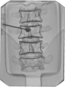 Lumbar Spine Fluoroscopy Training Phantom - vertebroplasty block