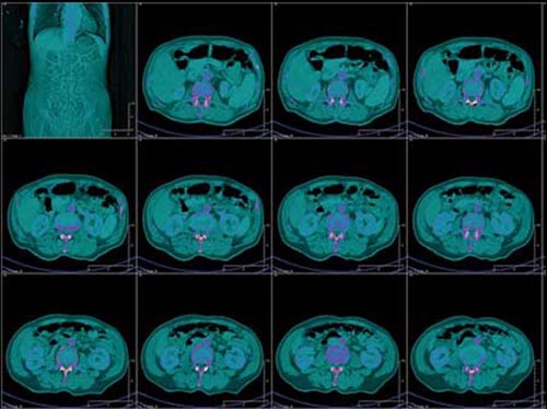 AttenuRad CT Scan Image