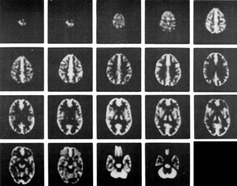 Hoffman 3-D Brain Phantom SPECT Images