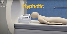 KyphoLift - kyphotic patient
