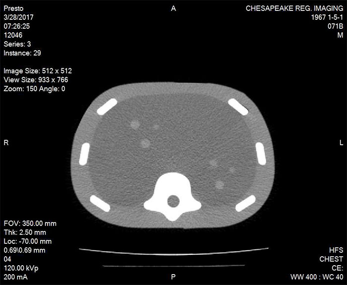 Image-Guided Abdominal Biopsy Phantom CIRS 071B CT Image