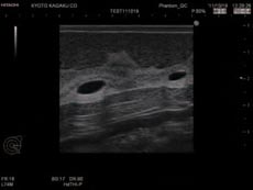 Ultrasound Scan 1