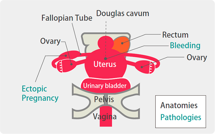 US-10 - Ectopic Pregnancy Phantom - Kyoto Kagaku