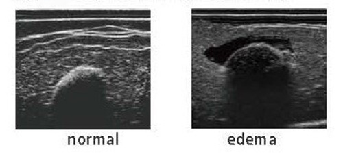 Pressure Sores Simulator - MW63 - Kyoto Kagaku - ultrasound