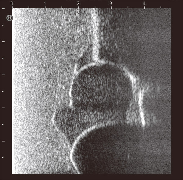 Infant Hip Sonography Training Phantom - Kyoto Kagaku - US-13 - Ultrasound