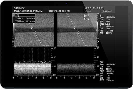 Volume flow settings on the phantom support reliable system velocity testing.