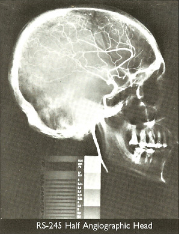 Angeiographic Head Phantom Image