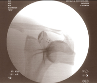 Fluoroscopic Image 6