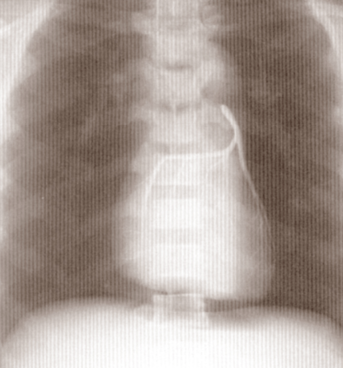 Lungs No Added Contrast