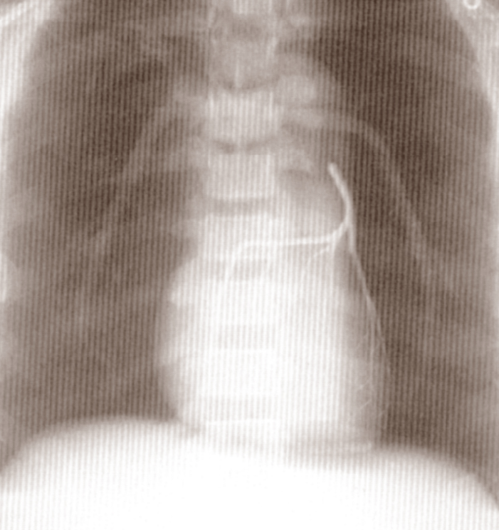 Lungs Low Contrast