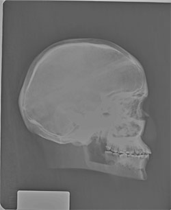 BREAK-APART PIXY Skull X-Ray