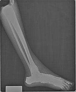BREAK-APART PIXY Ankle & Foot X-Ray 1