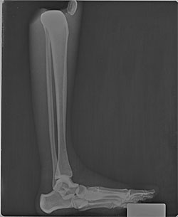 BREAK-APART PIXY Ankle & Foot X-Ray 2