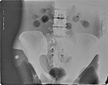 BREAK-APART PIXY Pelvis X-Ray