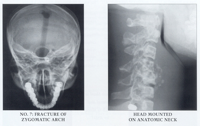 Head and Neck Phantom X-Ray