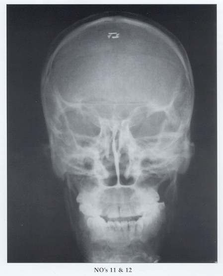 Wounded Willy and Damaged Debbie skull X-ray