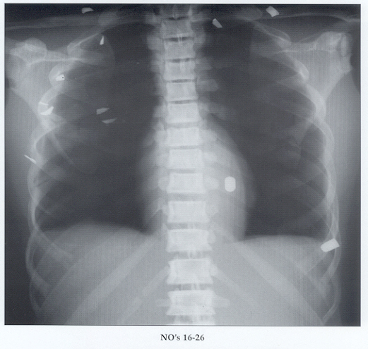 Phantom Chest X-Ray