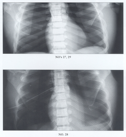 Chest X-Rays