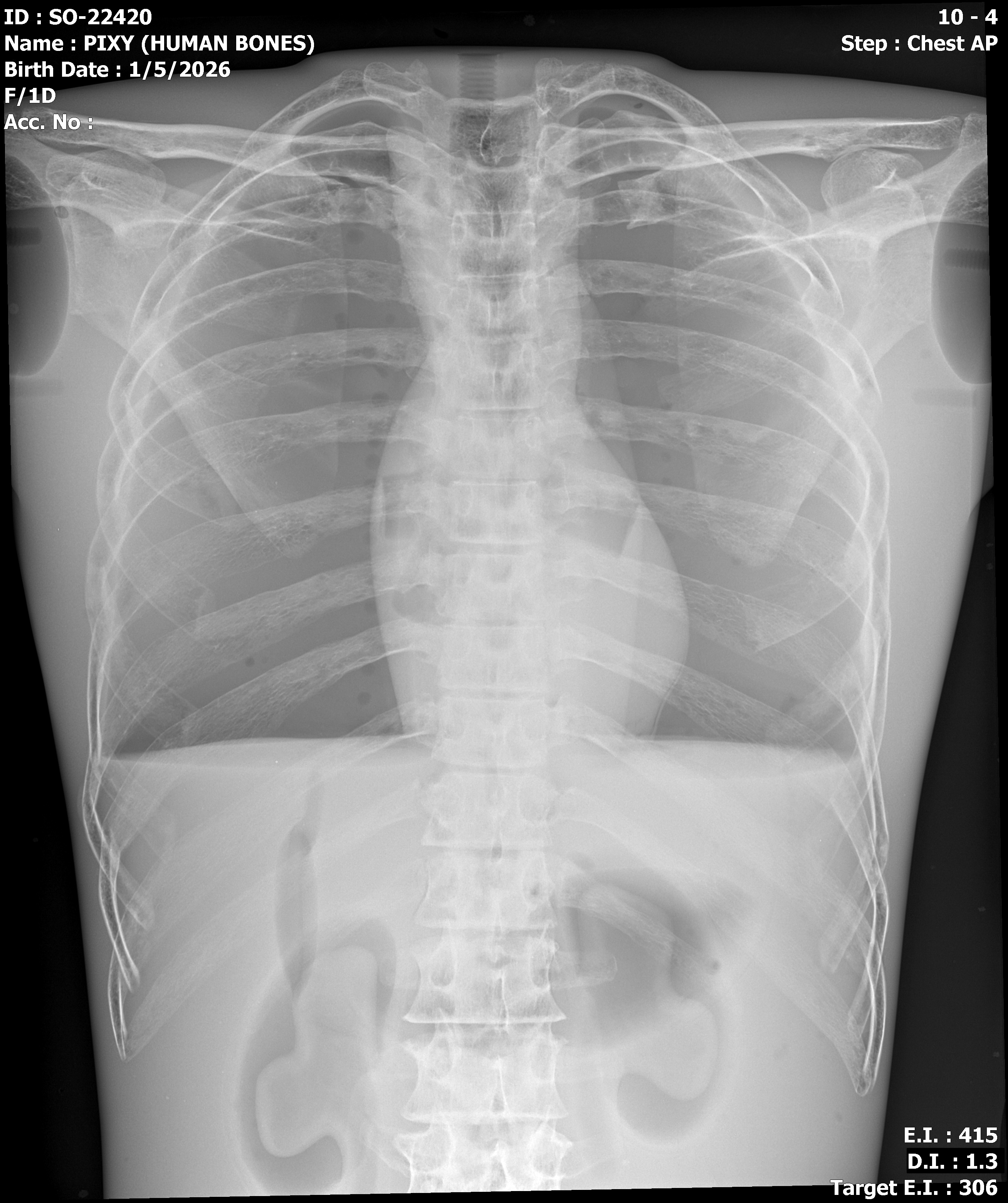 Cadaver bone full body phantom X-ray - chest AP view