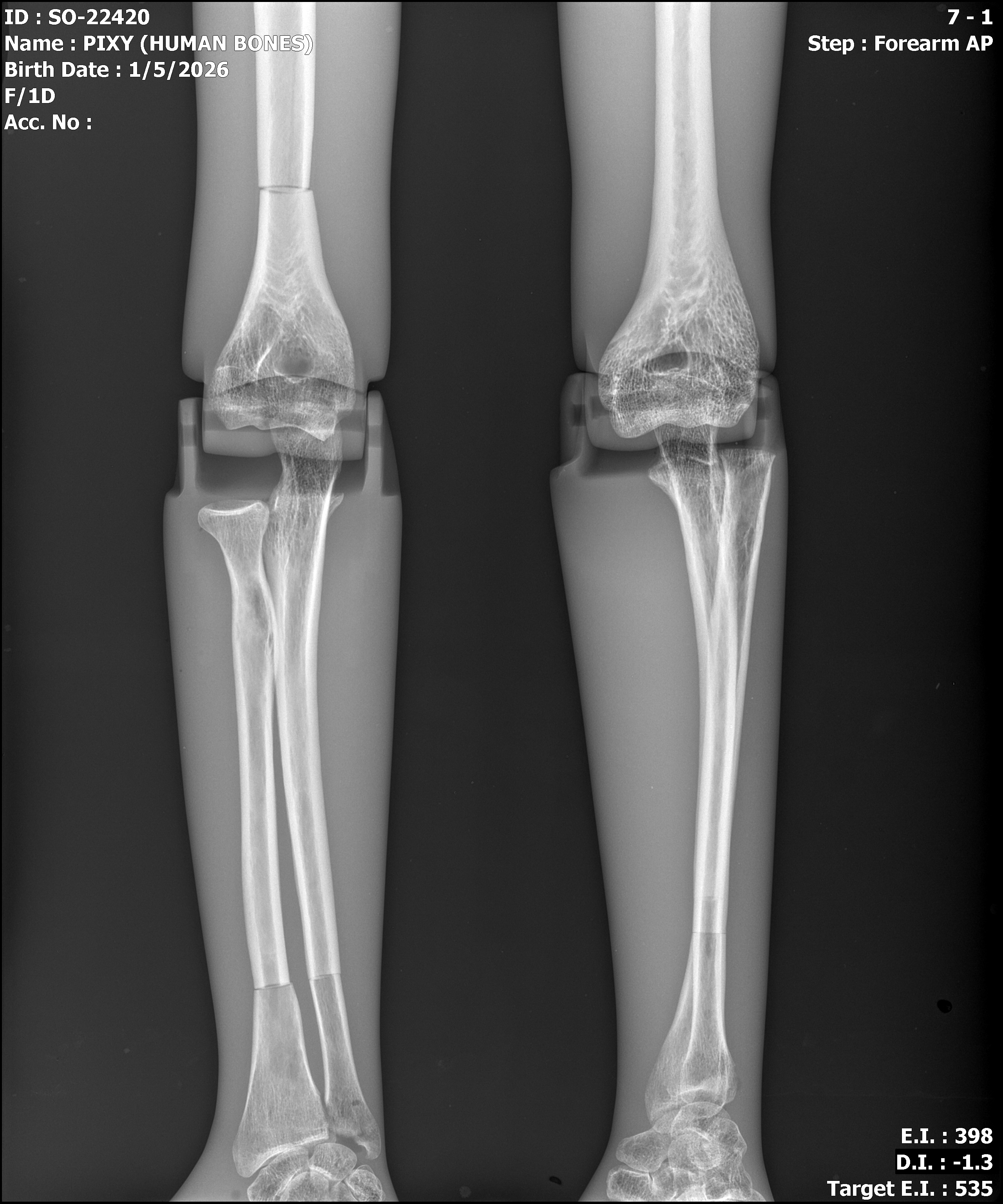 Cadaver bone full body phantom X-ray - elbow AP view
