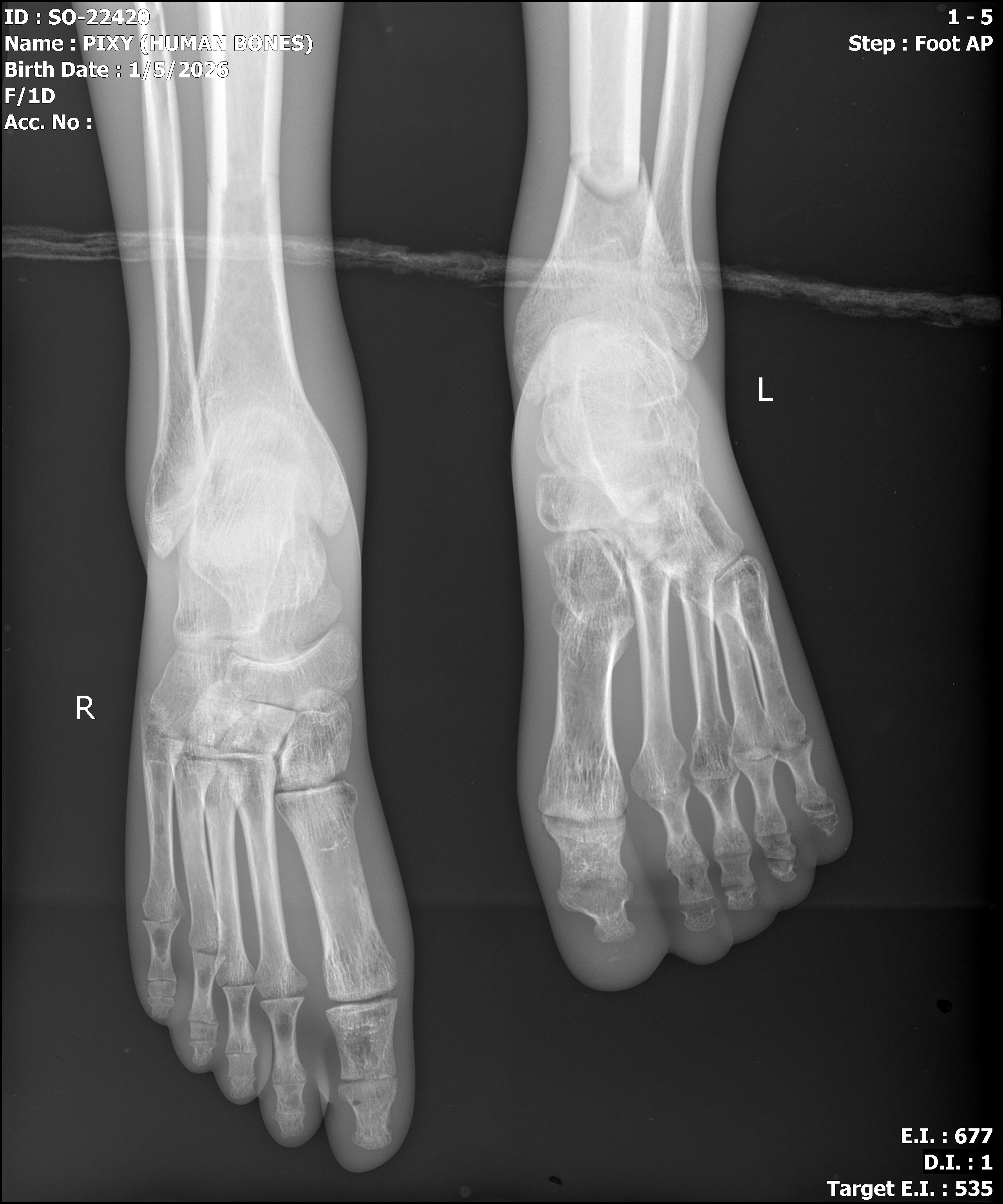 Cadaver bone full body phantom X-ray - feet AP view