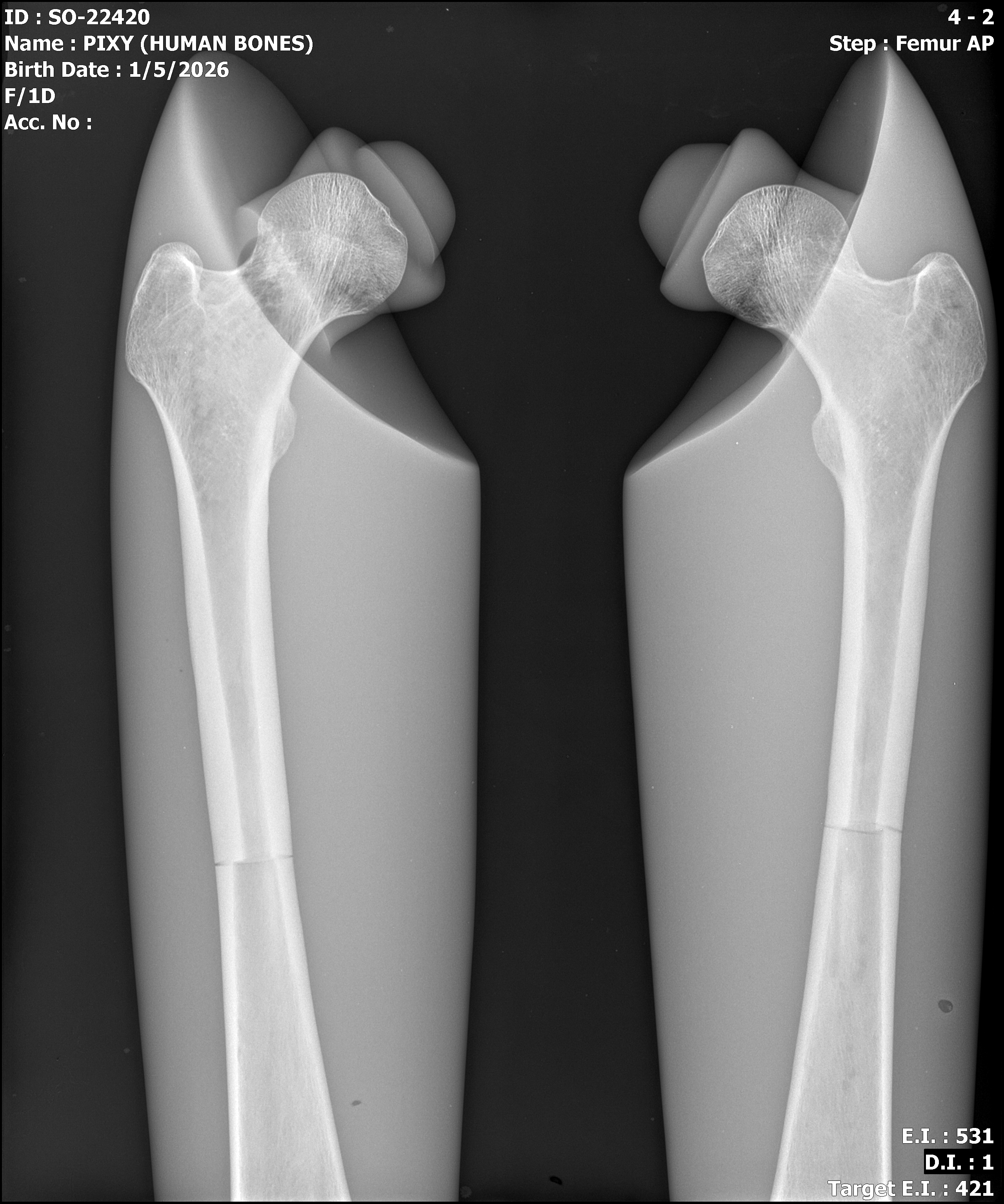 Cadaver bone full body phantom X-ray - femur AP view