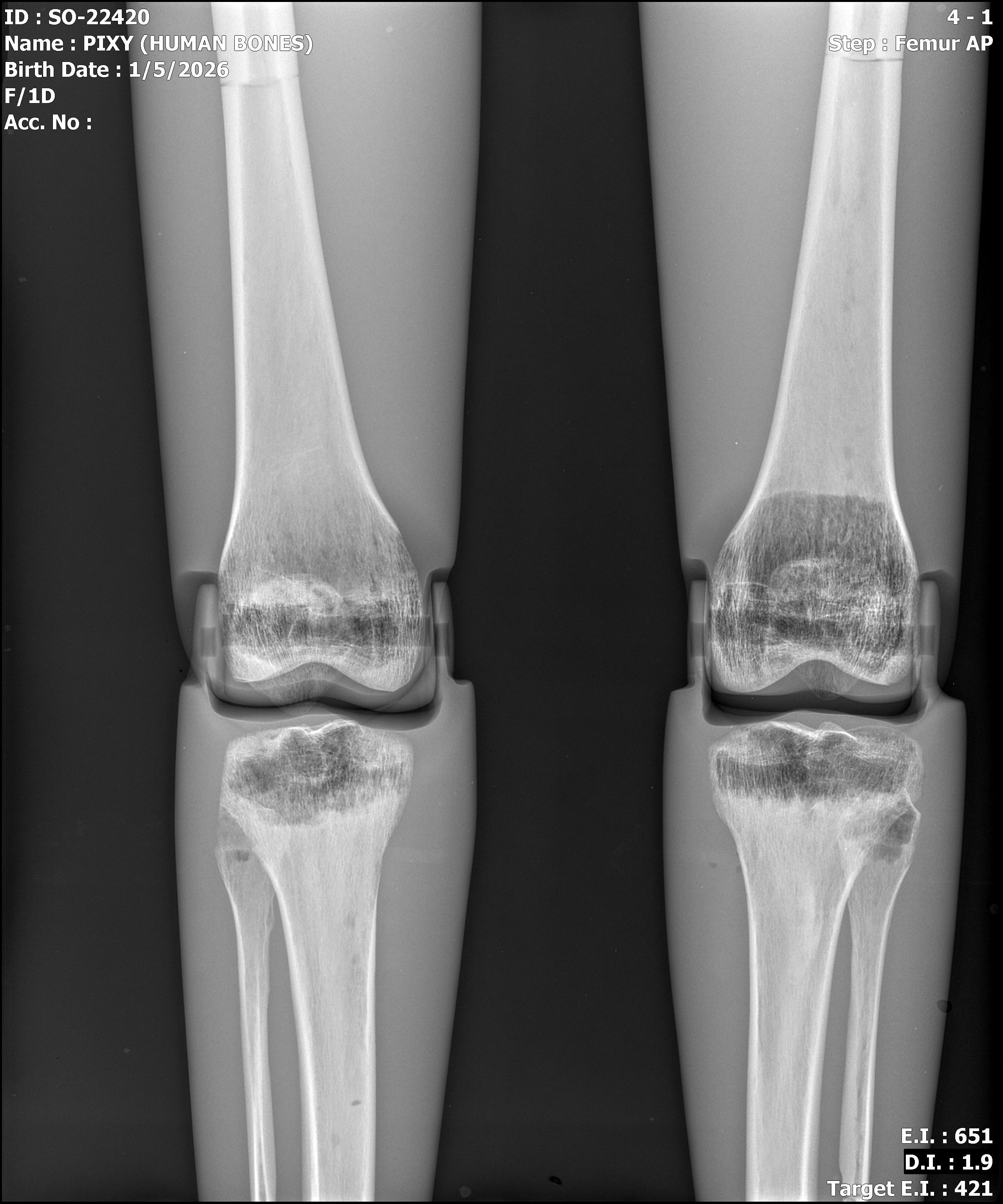 Cadaver bone full body phantom X-ray - knee AP view
