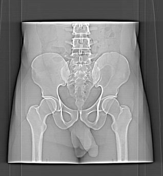 Virtually Human Male Pelvis Phantom X-Ray Image