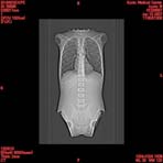PBU CT Scan Front Torso