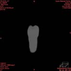 PBU CT Scan Front Torso
