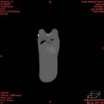 PBU CT Scan Front Torso