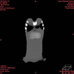 PBU CT Scan Front Torso