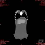PBU CT Scan Front Torso