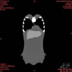 PBU CT Scan Front Torso