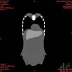 PBU CT Scan Front Torso
