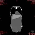 PBU CT Scan Front Torso