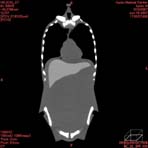 PBU CT Scan Front Torso