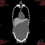 PBU CT Scan Front Torso