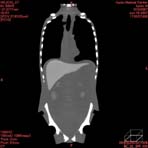 PBU CT Scan Front Torso