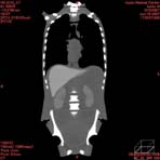 PBU CT Scan Front Torso