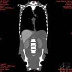 PBU CT Scan Front Torso