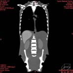 PBU CT Scan Front Torso