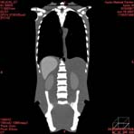 PBU CT Scan Front Torso