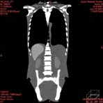PBU CT Scan Front Torso